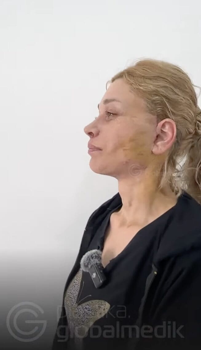  Complex facelift in Turkey