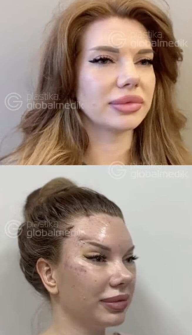 TEMPORAL Face Lift in Turkey