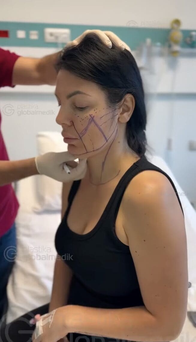 Facelift Transformation in Turkey |