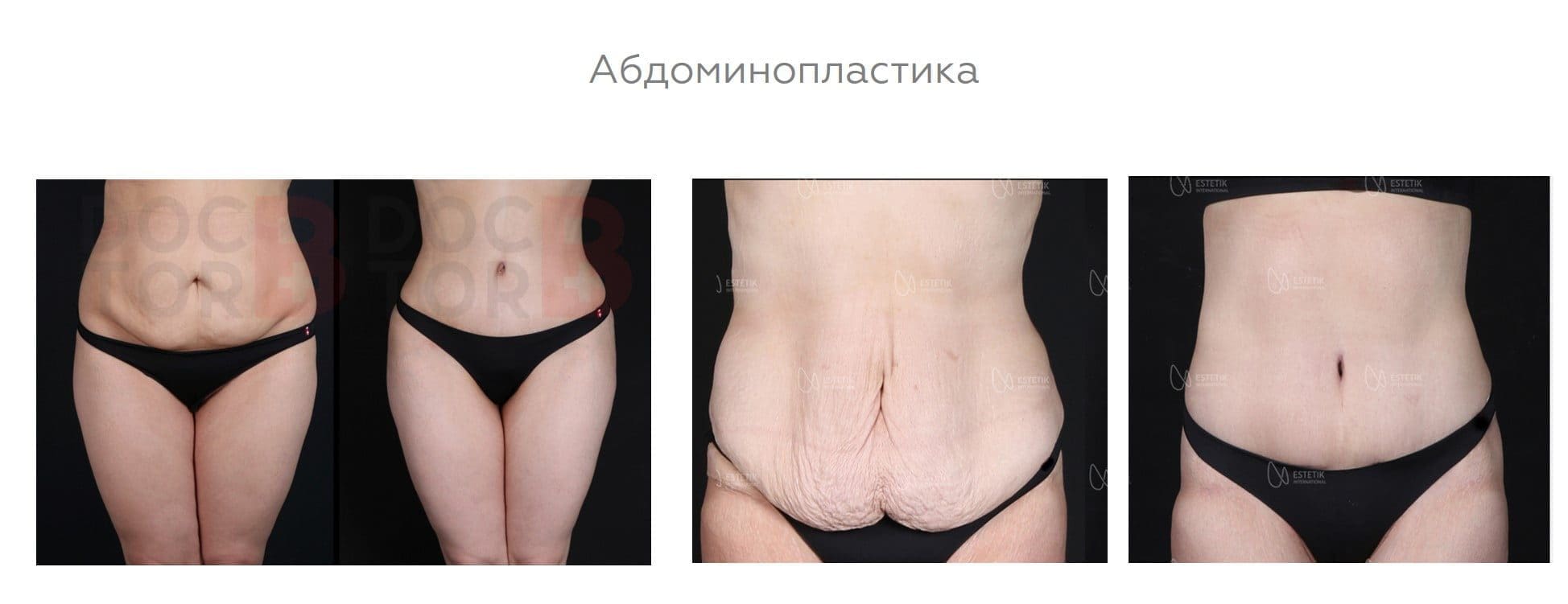 Абдоминопластика