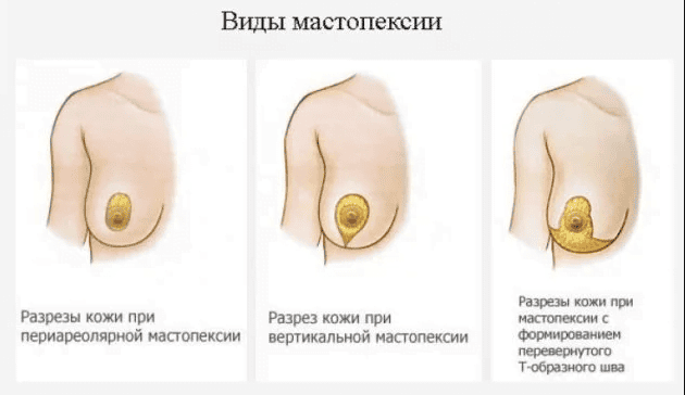 Виды подтяжки груди